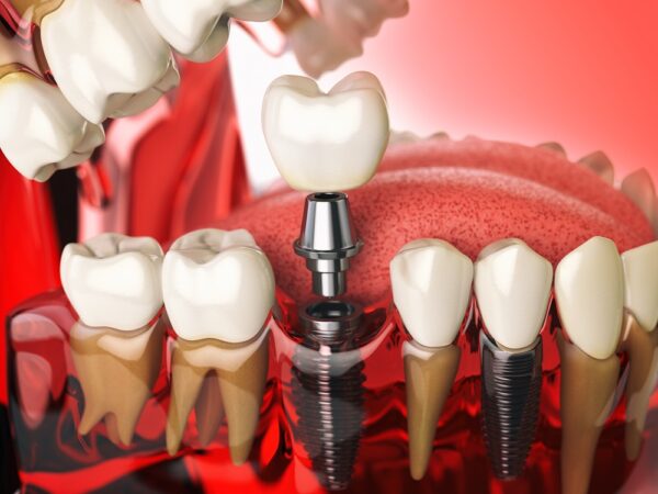 Implanty zębowe – najważniejsze zalety leczenia implantoprotetycznego