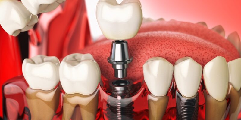 Implanty zębowe – najważniejsze zalety leczenia implantoprotetycznego